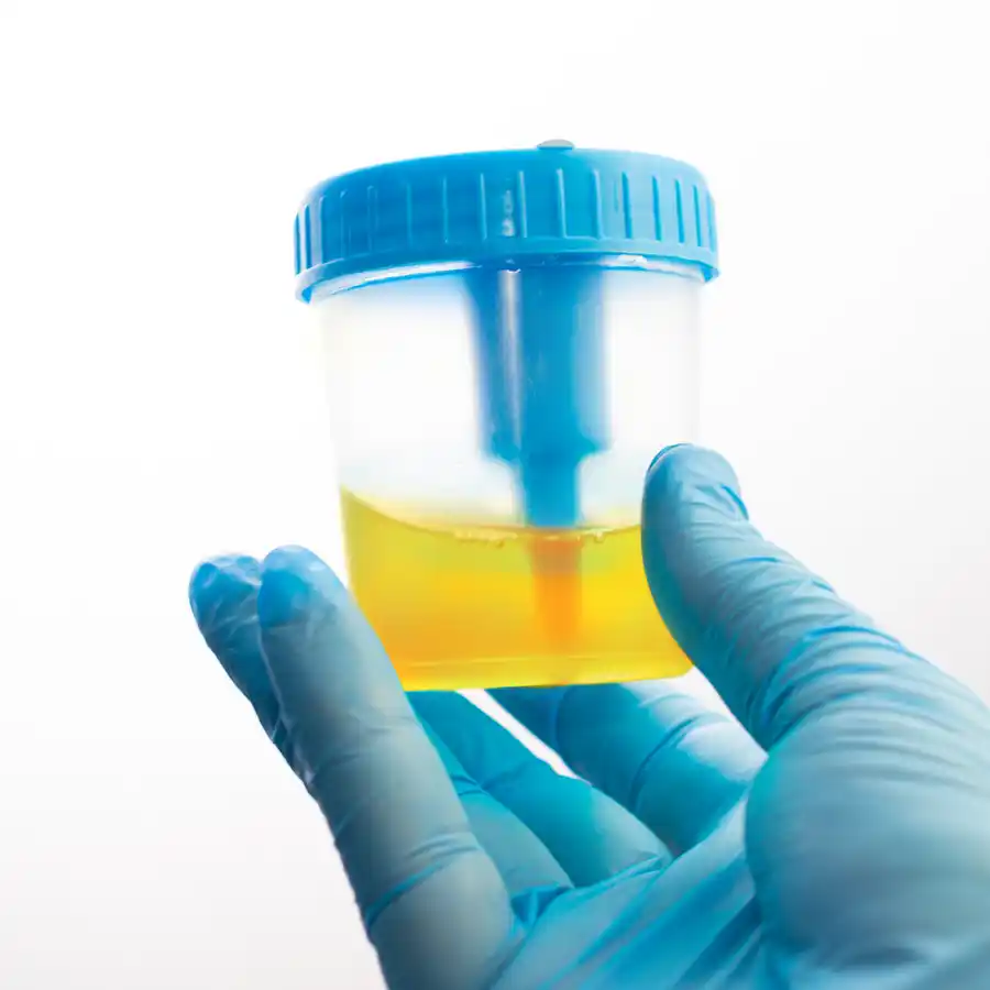 EVALUACIÓN DE ORINA POST-EYACULADO (EYACULACIÓN RETROGRADA)